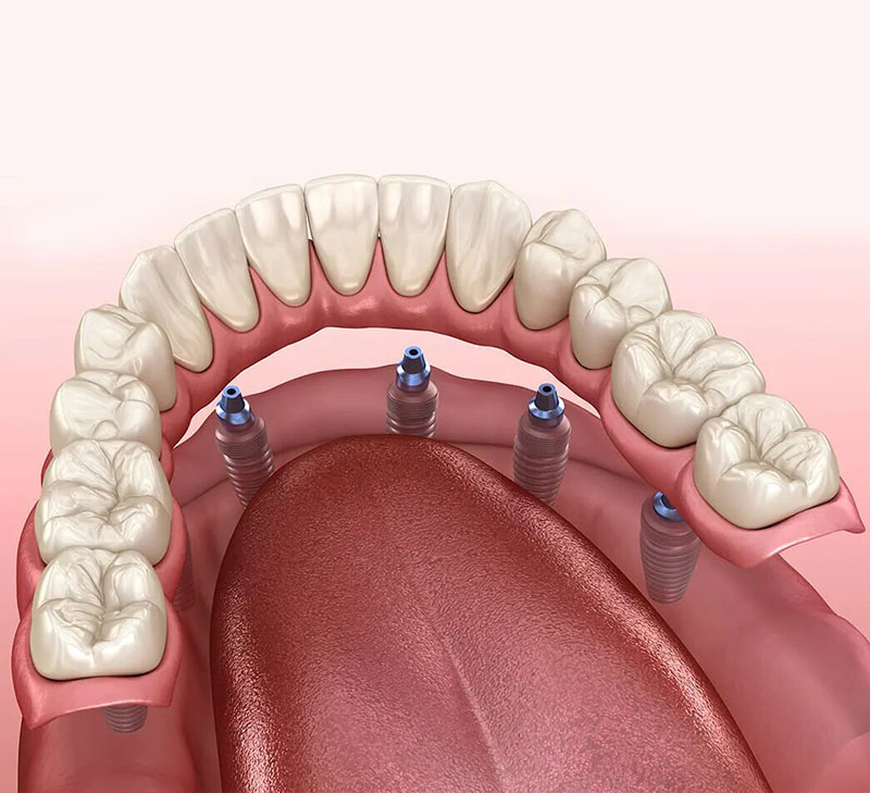 Implant-Supported Overdentures