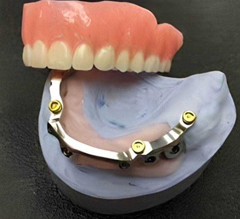 Bar Attachment Denture