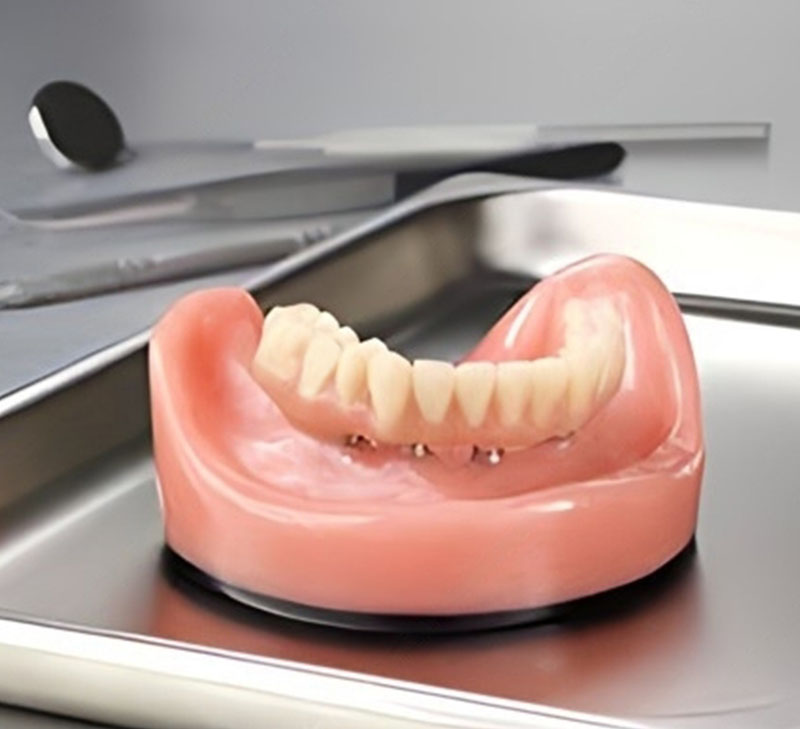 Screw Retained Denture