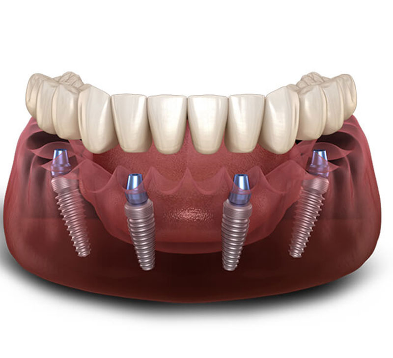 All-On-X Dental Implants