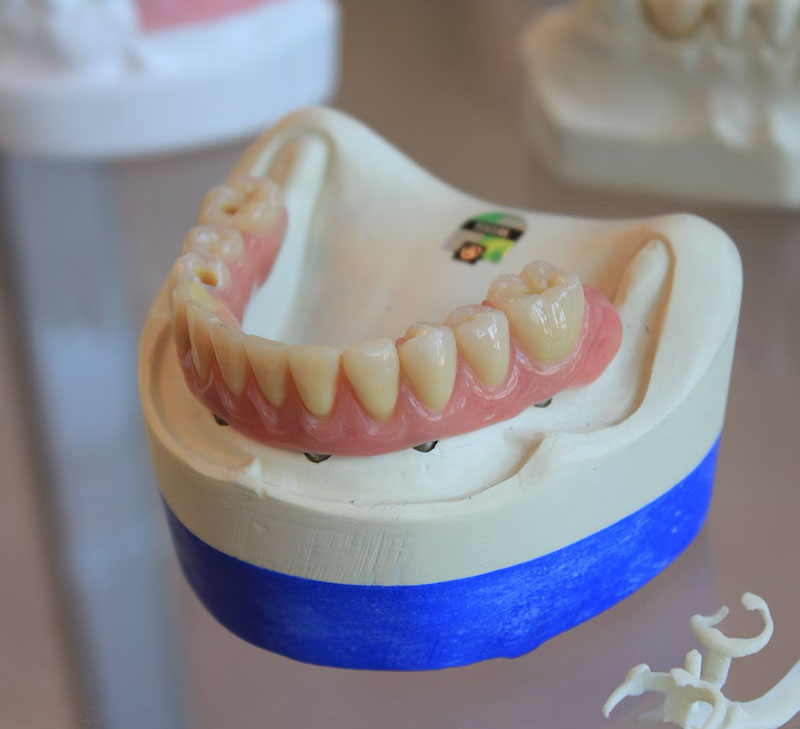 Ball Attachment Dentures
