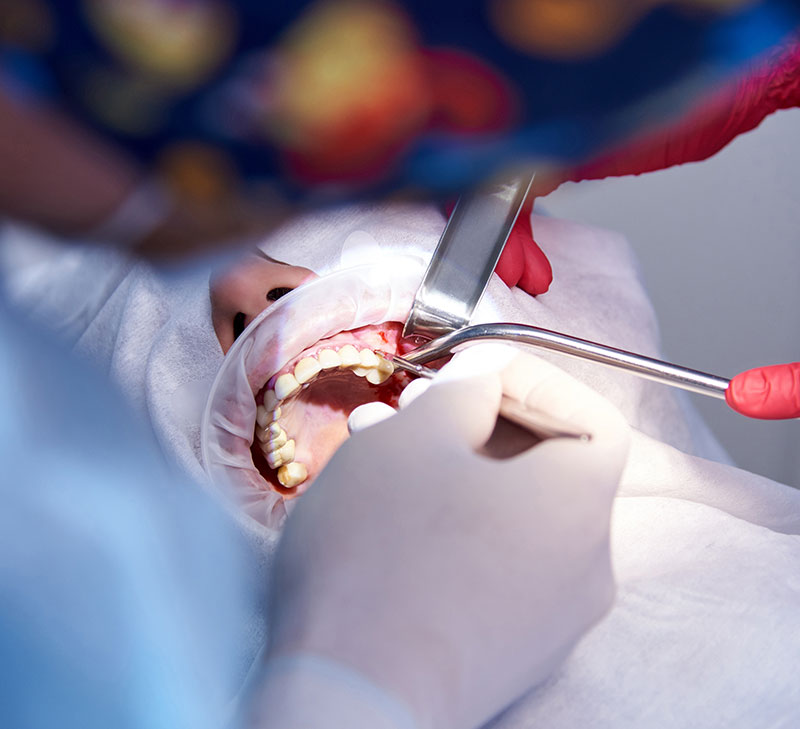 Expert Sinus Lift Procedures in Yorba Linda